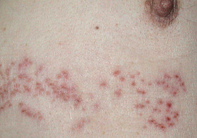 帯状疱疹症例4-2
